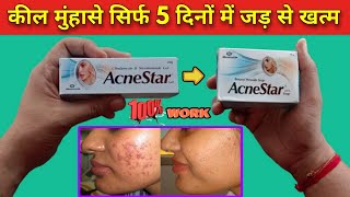 acnestar gel review एक्ने पिंपल्स जड़ से खत्म करने की दवा acnestar gel kaise use kare  acnestar [upl. by Ikcim968]