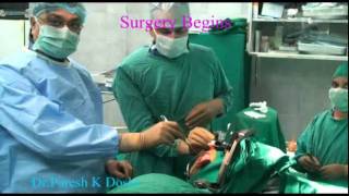 DBS Surgery for Parkinsons disease  DrParesh K Doshi [upl. by Afatsuom]