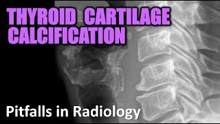 Thyroid Cartilage Calcification  Pitfalls in Radiology radiology xray [upl. by Hahnert]