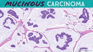 Primary Cutaneous Mucinous Carcinoma amp Endocrine MucinProducing Sweat Gland Carcinoma [upl. by Decrem]