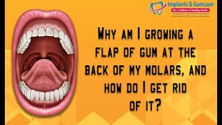 A flap of gum growing at the back of my molars  How do i get rid of it Carrollton Surgeon Vadivel [upl. by Falzetta]