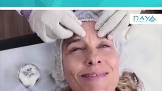 ACUPUNTURA ESTÉTICA FACIAL Y CORPORAL MICRONEEDLING [upl. by Ymereg]