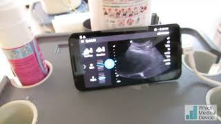 Nephrostomy with your smartphone [upl. by Nabois]