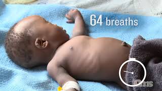 How to count respiration rate and notice chest indrawing in children [upl. by Thirion550]