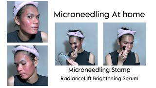 Microneedling At Home  Microneedling Stamp for Acne Scars  RadianceLift Brightening Serum [upl. by Nnyletak]