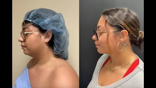 Watch Her Transform Chin Lipo Results [upl. by Primaveras]