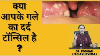 Tonsil Ka Ilaj  टॉन्सिल का उपचार  Tonsillitis Treatment In Hindi  Dr Poonam Poo [upl. by Hoang64]