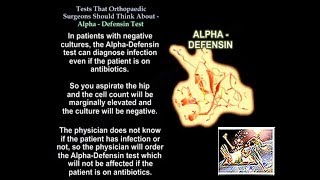 Alpha DefensinTests Ortho Surgeons Think About  Everything You Need To Know  Dr Nabil Ebraheim [upl. by Nwadal]