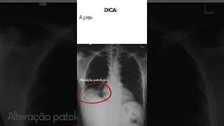 Radiografia do tórax com alteração patológica sugestivo de pneumonia [upl. by Southard]