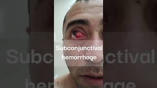 Subconjunctival hemorrhage ophthalmology hemorrhage health [upl. by Norby]