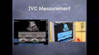 Tutorial Aorta amp IVC [upl. by Littman869]