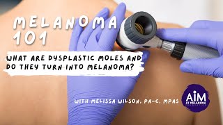 What are Dysplastic Moles and Do They Turn into Melanoma [upl. by Marla913]