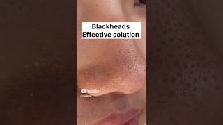 Blackheads amp Whiteheads Remedy skincare beauty beautytips [upl. by Eirual]