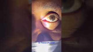 RAPD Relative Afferent Pupillary Defect [upl. by Krystal]