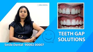 Teeth Gap Solutions smiledentalindia [upl. by Stew]