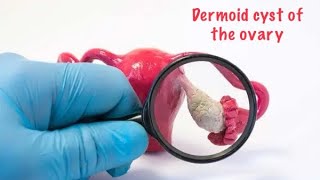 What is dermoid cyst  ovarian cyst   Dr JANANI [upl. by Ingelbert593]