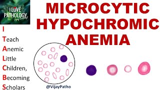 MICROCYTIC HYPOCHROMIC ANEMIA Causes Mechanism amp Approach [upl. by Afihtan]