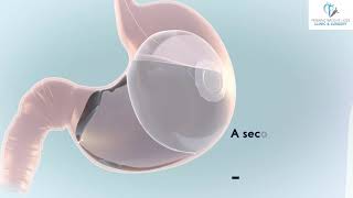 Elipse Intragastric Balloon Animation Video [upl. by Herzog]