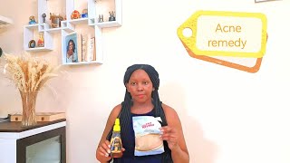 Acne home remedy that Works with 2 simple ingredients 💯❤️✅ [upl. by Snoddy]