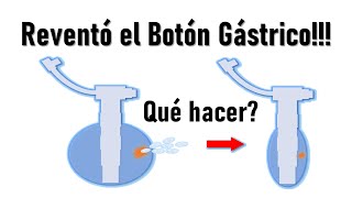 😱SE ROMPIÓ el botón de Gastrostomía😱 Cómo SOLUCIONARLO FÁCIL💚💚 [upl. by Krutz389]