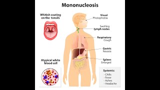 Infectious mononucleosis Causes Signs and Symptoms Diagnosis and Treatment [upl. by Harmon]