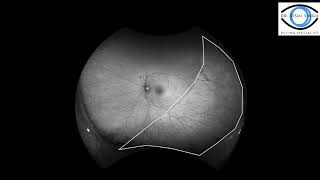 Multimodal imaging to distinguish retinal detachments from retinoschisis [upl. by Ackley]