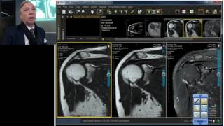 MRI Case Review Breaking All the Rules  Adhesive Capsulitis [upl. by Lianne749]