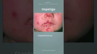 Impetigo  What is it and what is the treatment shorts [upl. by Eiznik]