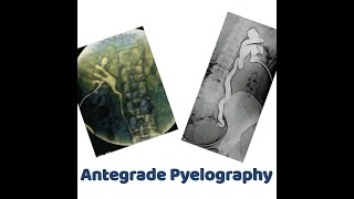 antegrade Pyelography [upl. by Yorgos]