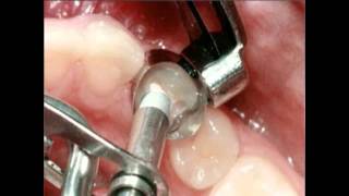 Amalgam Fillings Procedure  Lake Merritt Dental Oakland CA [upl. by Eyahsal]