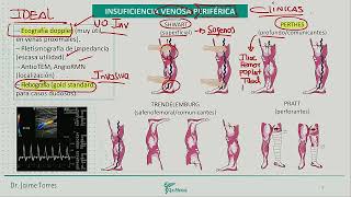 Cardiología  Insuficiencia venosa periferica TVP [upl. by Dorice660]