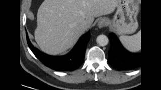 Urothelial neoplasm [upl. by Willy285]