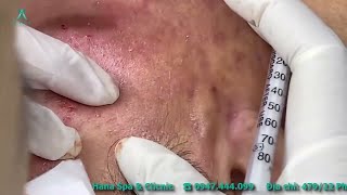 Big Cystic Acne Blackheads Extraction Blackheads amp Milia Whiteheads Removal Pimple Popping [upl. by Yelak924]