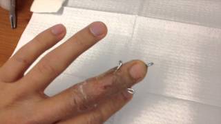 Broken finger pin removal [upl. by Llertnahs676]