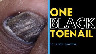 One Black Toenail Fungal Toenail Infection or Not [upl. by Narahs]