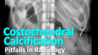 Costochondral Calcification  Pitfalls in Radiology radiology [upl. by Nahoj]