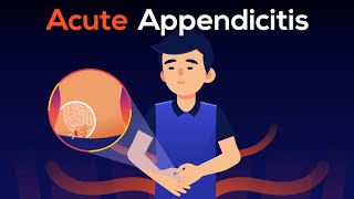 What is Appendicitis A real case of Burst Appendix [upl. by Alliw]