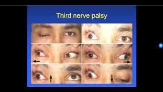 Diplopia 26  Types of Strabismus [upl. by Akihsat222]