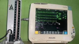 Heartbeat and BP Measurement while Tachycardia Episode w ECG monitor [upl. by Aikehs]