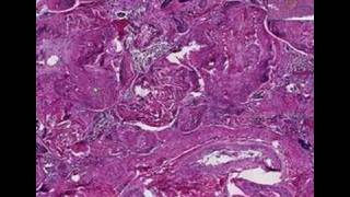 Histopathology SpleenSickle cell disease [upl. by Roland]