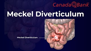 Meckel Diverticulum [upl. by Janey]