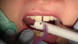 How to close gap between front teeth Cosmetic Dentistry Los Angeles CA Tel 8187760055 [upl. by Hardner823]