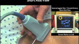 How To Ultrasound Guidance for Central Venous Access Part 1 Case Study [upl. by Hamian214]