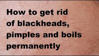 How to get rid of blackheads pimples and boils permanently [upl. by Egreog]