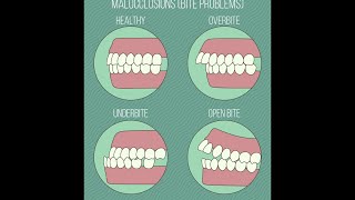 Different Types of Malocclusions [upl. by Llenehc]