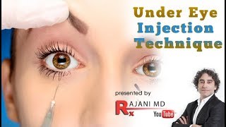 Under Eye Injection Technique [upl. by Jeremiah]