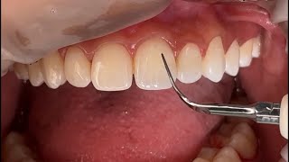 ASMR Dental scaling [upl. by Annekam]