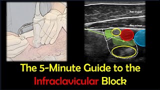 Infraclavicular Brachial Plexus Block  a quotHowToquot Guide [upl. by Peedus]