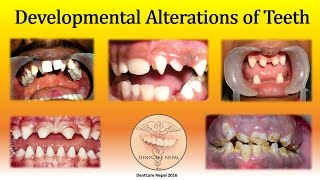 Developmental Defects of Teeth  Oral Pathology [upl. by Ltihcox]