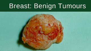 Breast Benign Tumours  Pathology mini tutorial [upl. by Jat]